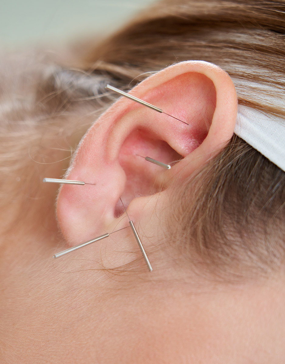 Kulak Akupunkturu (Aurikülopati) 